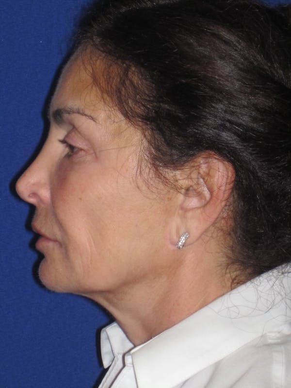 Facelift/Mini-Facelift Before & After Gallery - Patient 4890410 - Image 5