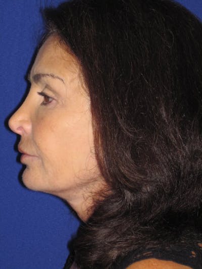 Facelift/Mini-Facelift Before & After Gallery - Patient 4890410 - Image 6