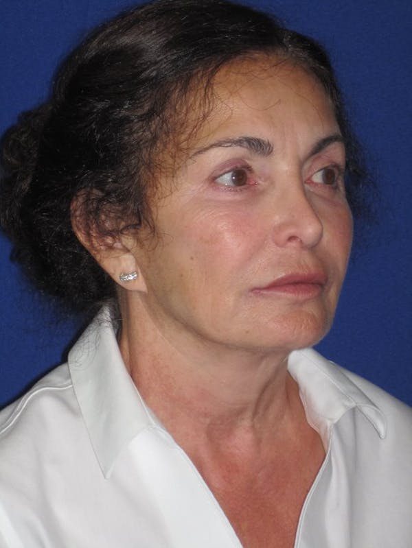 Facelift/Mini-Facelift Before & After Gallery - Patient 4890410 - Image 7
