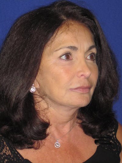 Facelift/Mini-Facelift Before & After Gallery - Patient 4890410 - Image 8