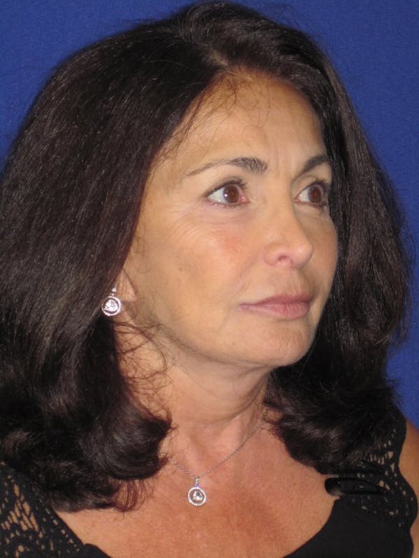 Facelift/Mini-Facelift Before & After Gallery - Patient 4890410 - Image 8