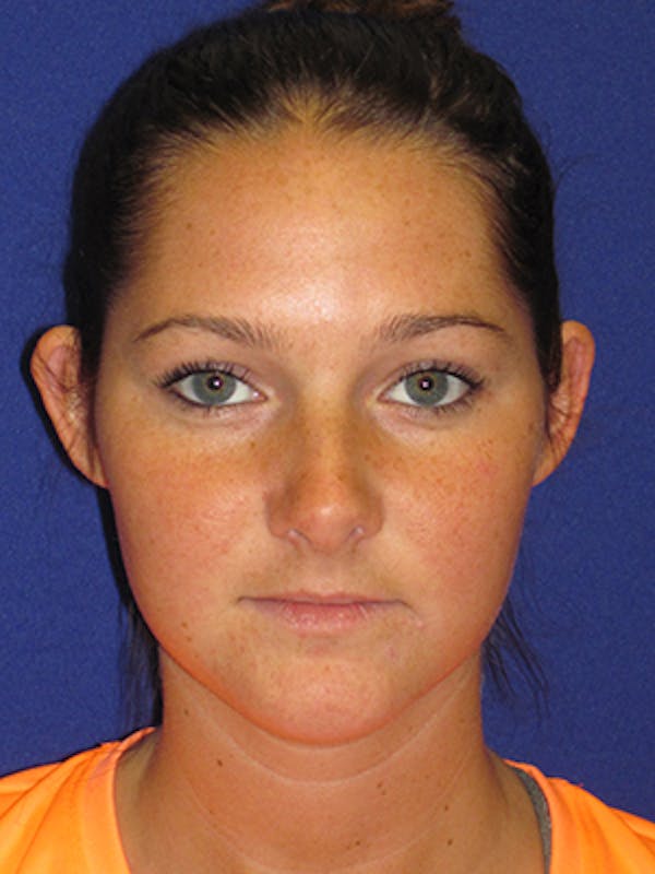 Otoplasty 