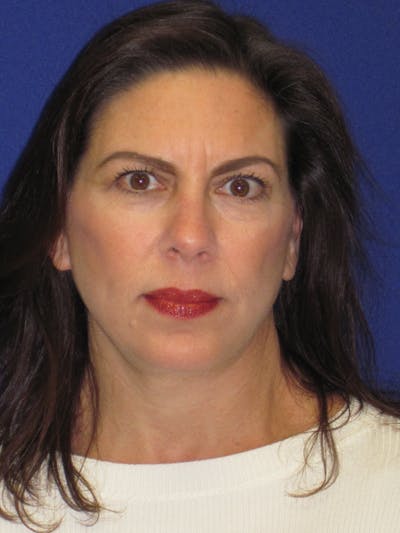 Facelift/Mini-Facelift Before & After Gallery - Patient 4890419 - Image 2