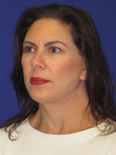 Facelift/Mini-Facelift Before & After Gallery - Patient 4890419 - Image 4