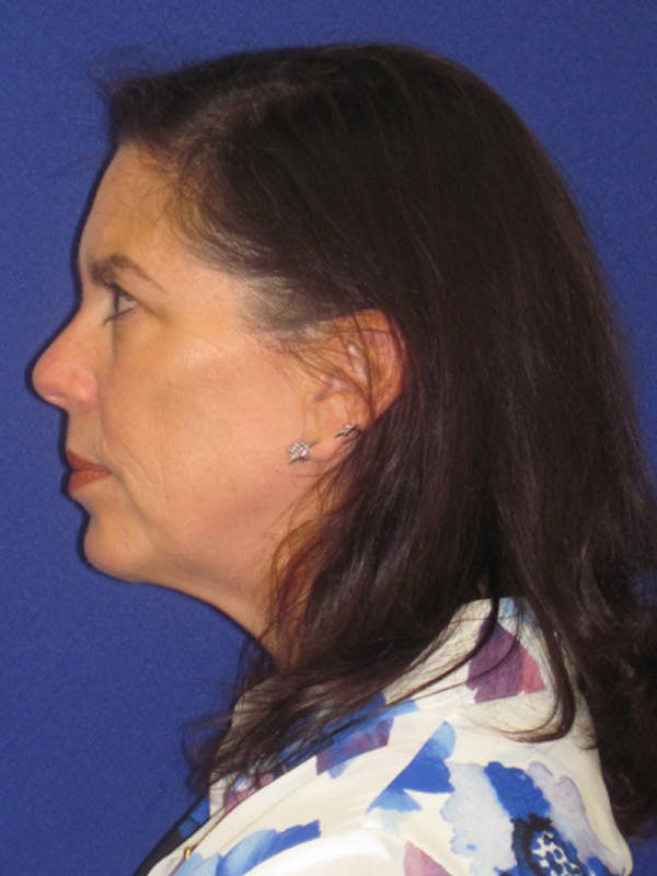 Facelift/Mini-Facelift Before & After Gallery - Patient 4890419 - Image 5