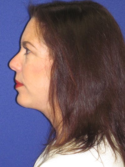 Facelift/Mini-Facelift Before & After Gallery - Patient 4890419 - Image 6