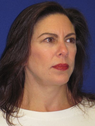 Facelift/Mini-Facelift Before & After Gallery - Patient 4890419 - Image 8
