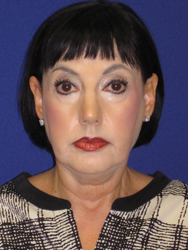 Facelift/Mini-Facelift Before & After Gallery - Patient 4890427 - Image 1