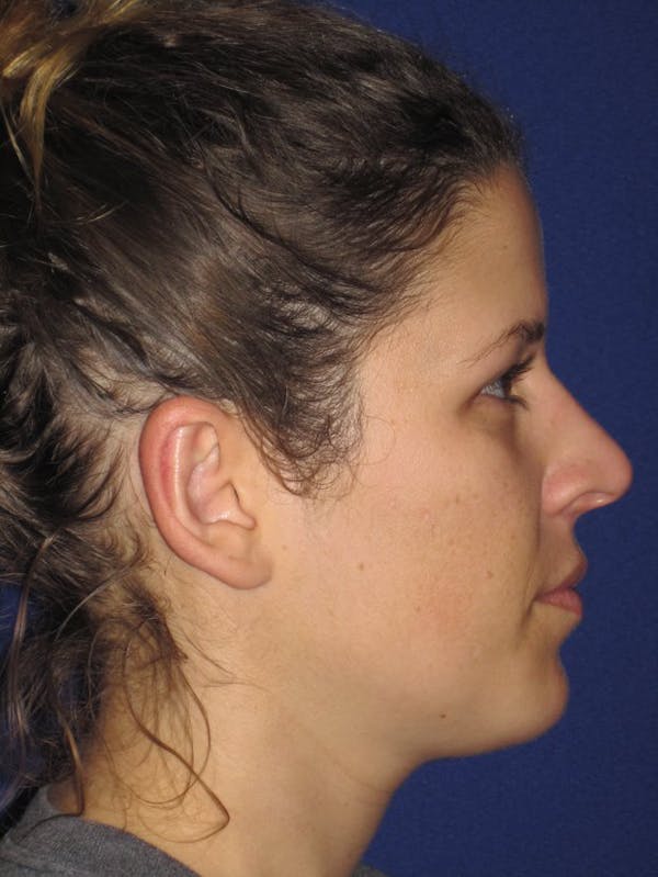 Otoplasty 