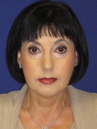 Facelift/Mini-Facelift Before & After Gallery - Patient 4890427 - Image 2