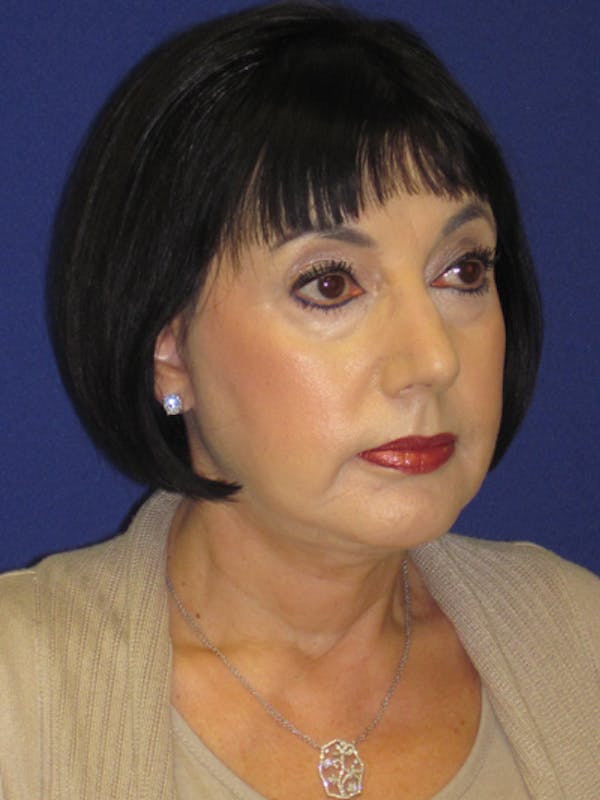 Facelift/Mini-Facelift Before & After Gallery - Patient 4890427 - Image 4