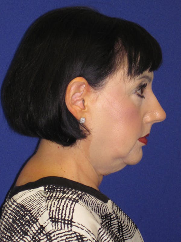 Facelift/Mini-Facelift Before & After Gallery - Patient 4890427 - Image 5