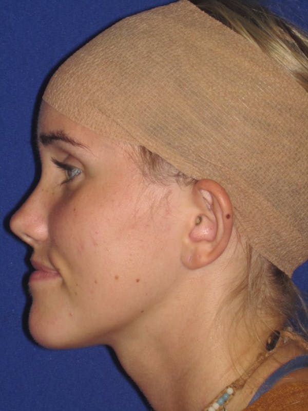 Otoplasty 