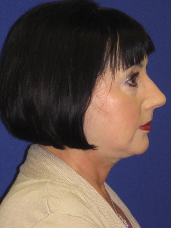 Facelift/Mini-Facelift Before & After Gallery - Patient 4890427 - Image 6