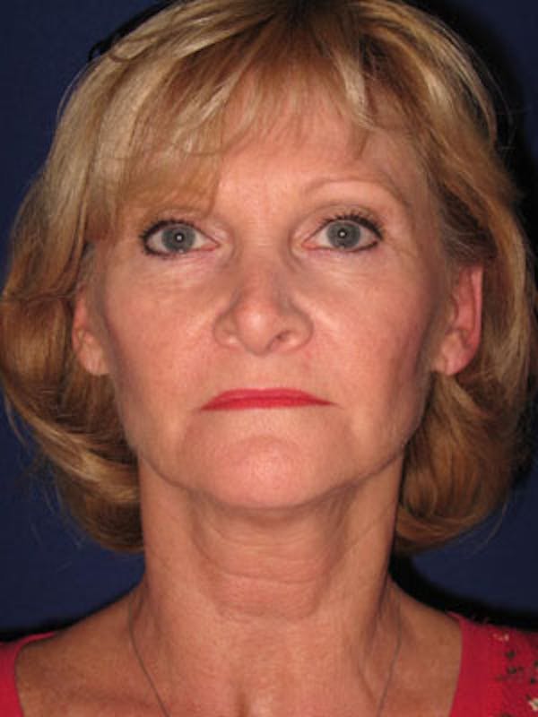 Facelift/Mini-Facelift Before & After Gallery - Patient 4890429 - Image 1