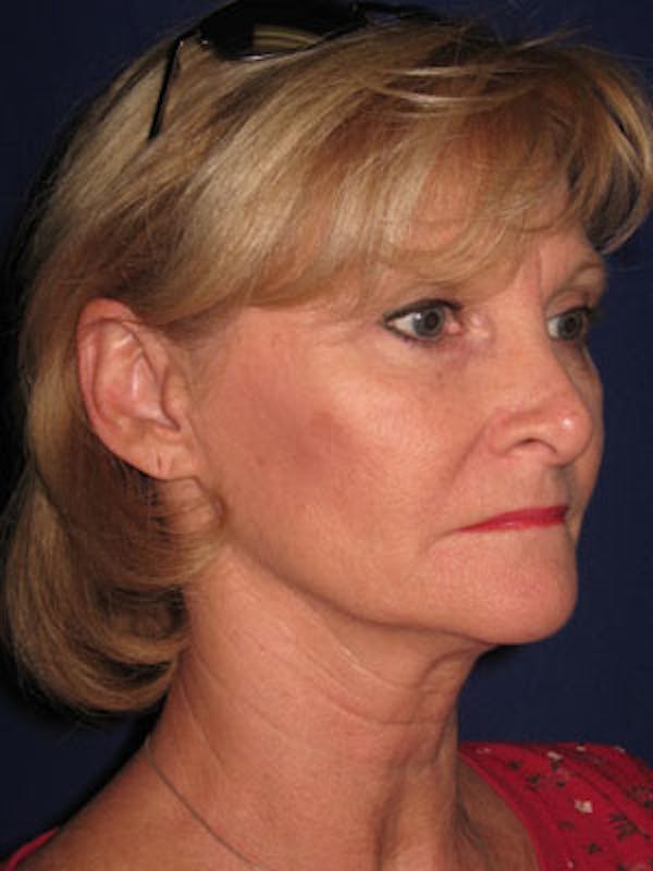 Facelift/Mini-Facelift Before & After Gallery - Patient 4890429 - Image 3