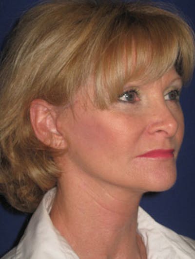 Facelift/Mini-Facelift Before & After Gallery - Patient 4890429 - Image 4