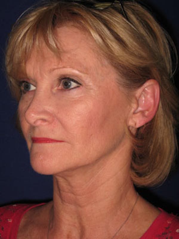 Facelift/Mini-Facelift Before & After Gallery - Patient 4890429 - Image 5