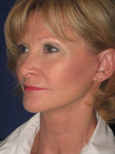 Facelift/Mini-Facelift Before & After Gallery - Patient 4890429 - Image 6