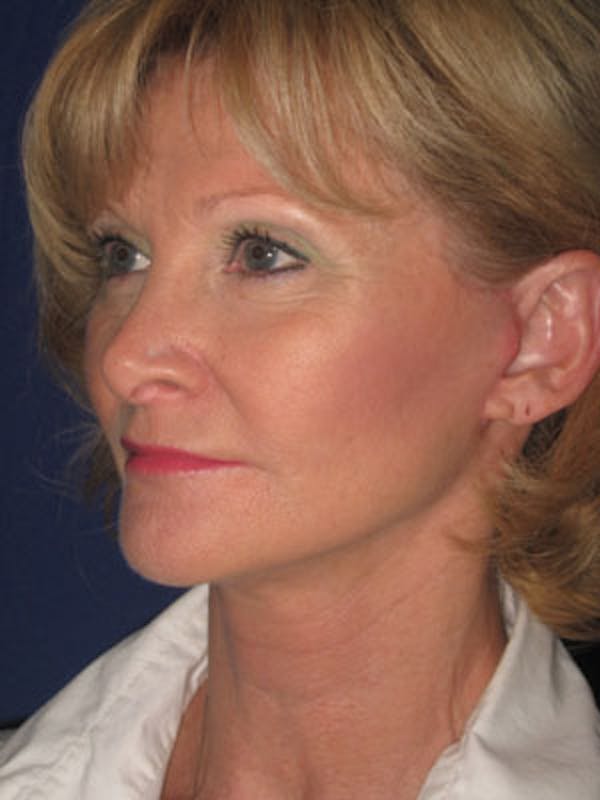 Facelift/Mini-Facelift Before & After Gallery - Patient 4890429 - Image 6