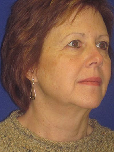 Facelift/Mini-Facelift Before & After Gallery - Patient 4890434 - Image 1