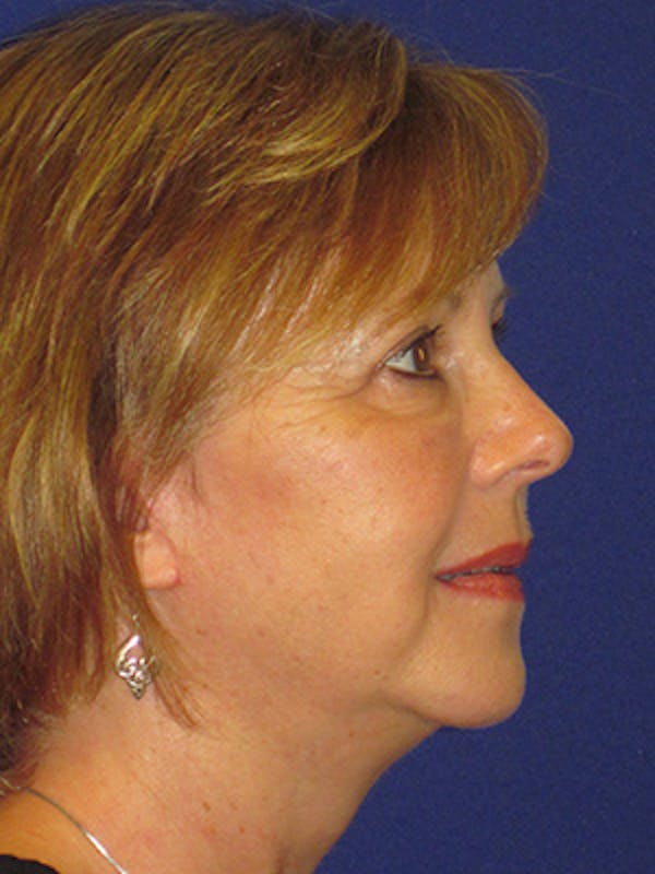 Facelift/Mini-Facelift Before & After Gallery - Patient 4890434 - Image 4
