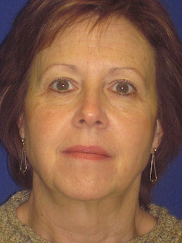 Facelift/Mini-Facelift Before & After Gallery - Patient 4890434 - Image 5