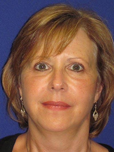 Facelift/Mini-Facelift Before & After Gallery - Patient 4890434 - Image 6