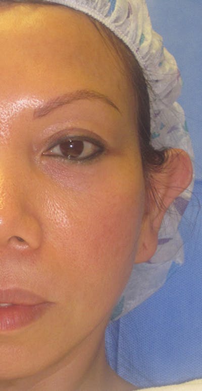 Otoplasty 