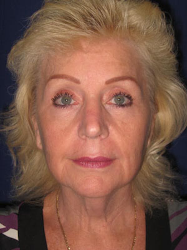Facelift/Mini-Facelift Before & After Gallery - Patient 4890437 - Image 1