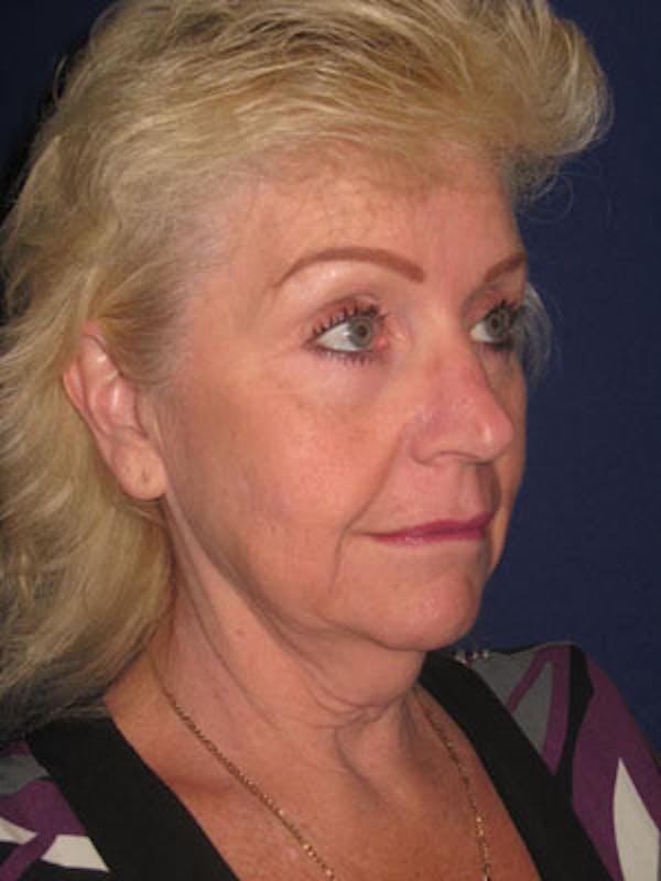 Facelift/Mini-Facelift Before & After Gallery - Patient 4890437 - Image 3
