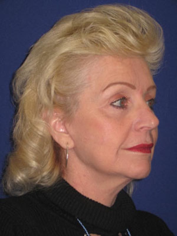 Facelift/Mini-Facelift Before & After Gallery - Patient 4890437 - Image 4