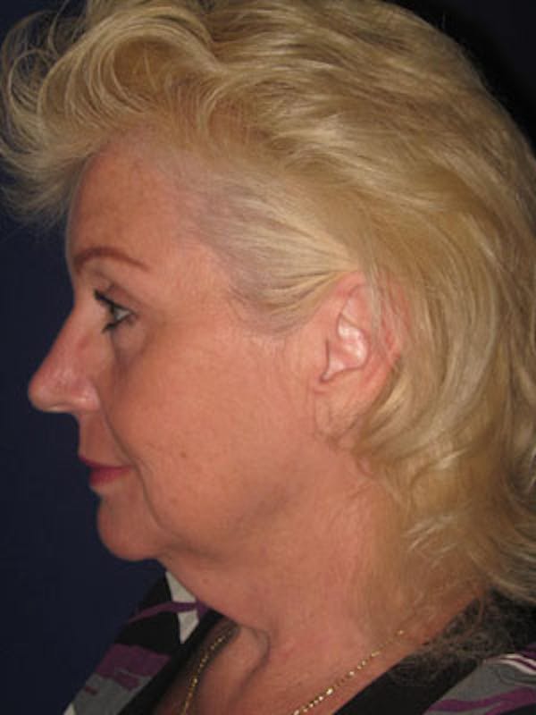 Facelift/Mini-Facelift Before & After Gallery - Patient 4890437 - Image 5