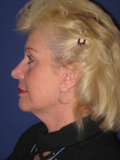 Facelift/Mini-Facelift Before & After Gallery - Patient 4890437 - Image 6