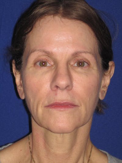 Facelift/Mini-Facelift Before & After Gallery - Patient 4890441 - Image 1