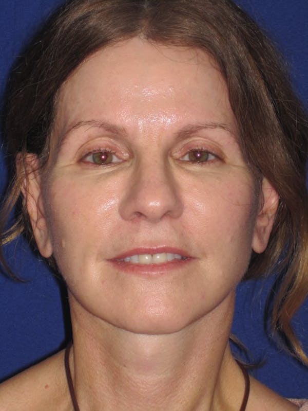 Facelift/Mini-Facelift Before & After Gallery - Patient 4890441 - Image 2