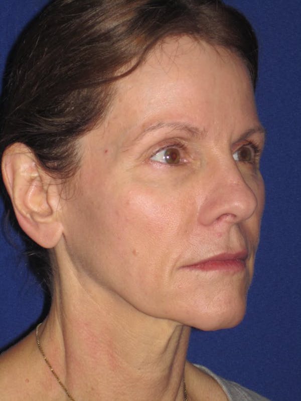 Facelift/Mini-Facelift Before & After Gallery - Patient 4890441 - Image 3