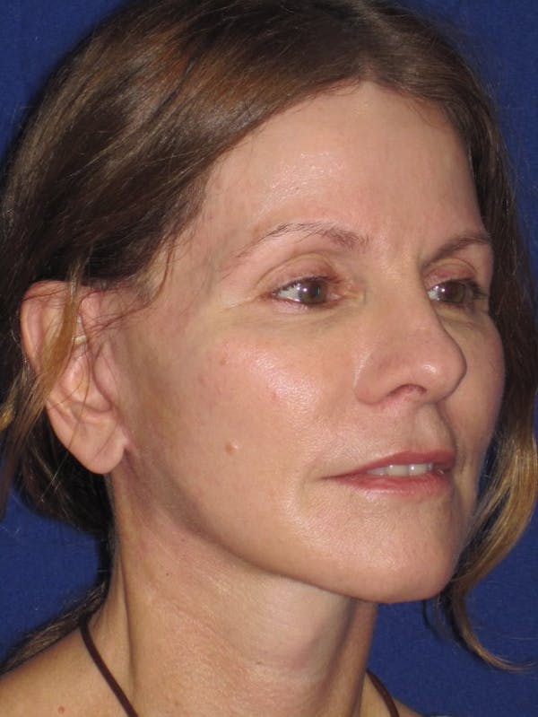 Facelift/Mini-Facelift Before & After Gallery - Patient 4890441 - Image 4
