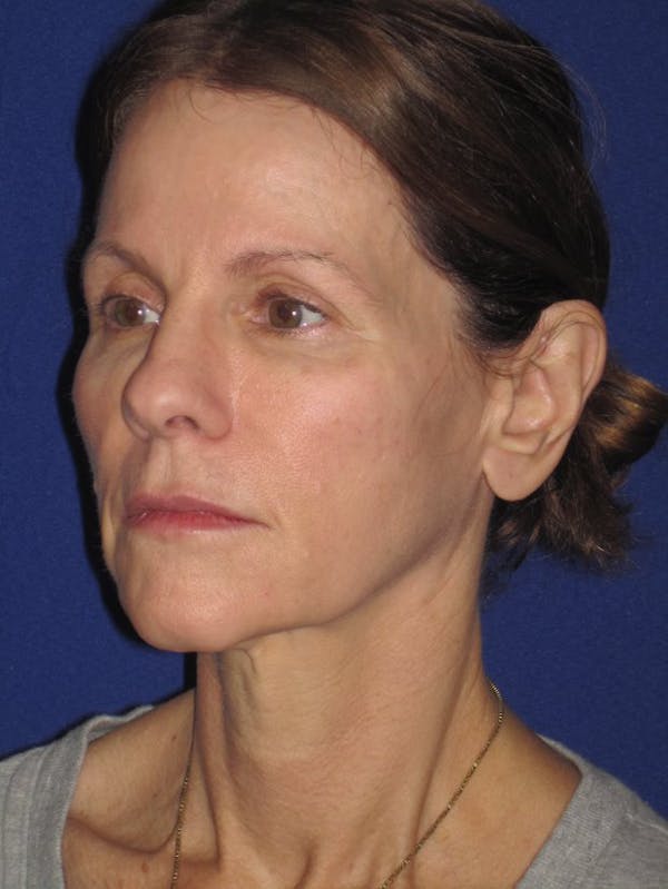 Facelift/Mini-Facelift Before & After Gallery - Patient 4890441 - Image 5