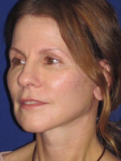 Facelift/Mini-Facelift Before & After Gallery - Patient 4890441 - Image 6