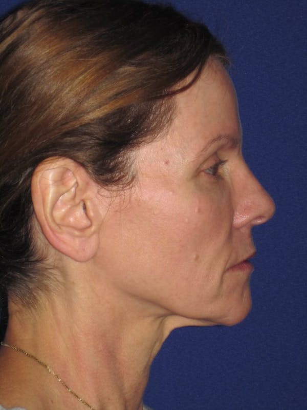 Facelift/Mini-Facelift Before & After Gallery - Patient 4890441 - Image 7