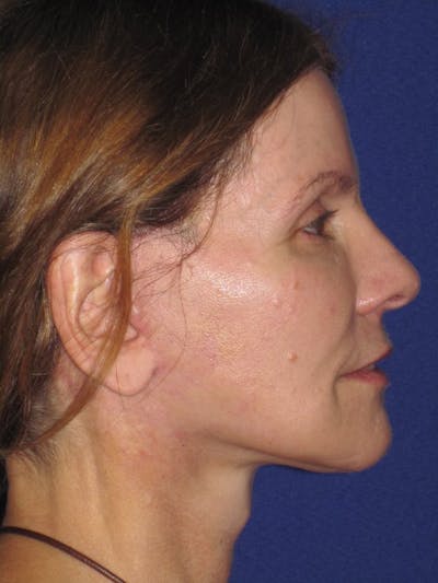 Facelift/Mini-Facelift Before & After Gallery - Patient 4890441 - Image 8