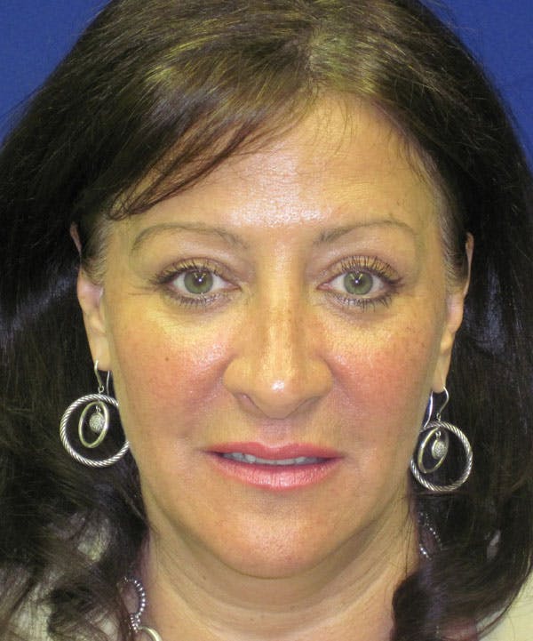 Facelift/Mini-Facelift Before & After Gallery - Patient 4890450 - Image 1