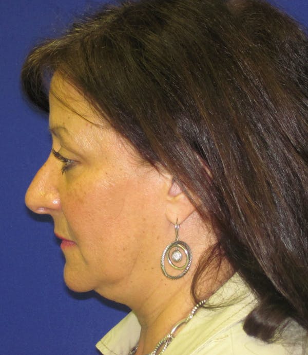 Facelift/Mini-Facelift Before & After Gallery - Patient 4890450 - Image 3