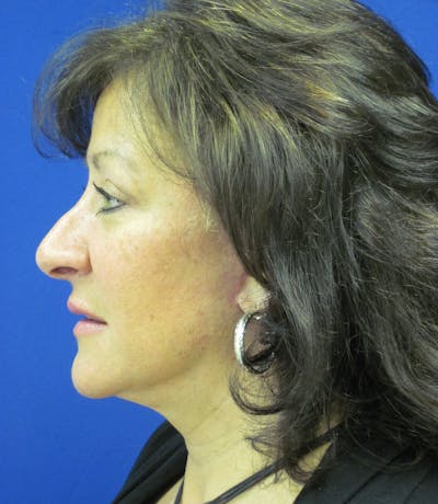 Facelift/Mini-Facelift Before & After Gallery - Patient 4890450 - Image 4