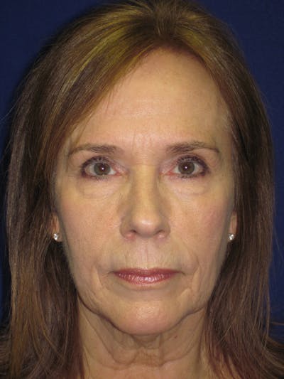 Facelift/Mini-Facelift Before & After Gallery - Patient 4890484 - Image 1