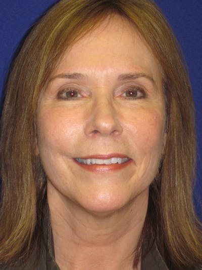 Facelift/Mini-Facelift Before & After Gallery - Patient 4890484 - Image 2