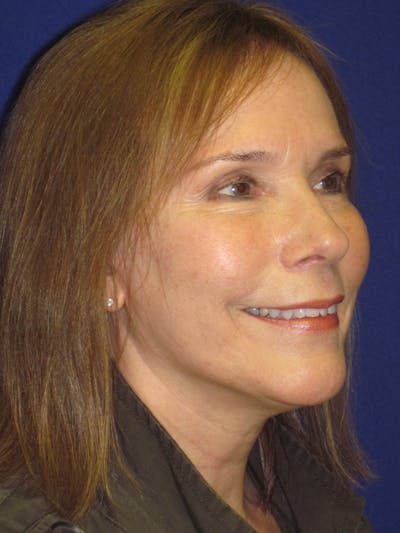 Facelift/Mini-Facelift Before & After Gallery - Patient 4890484 - Image 4