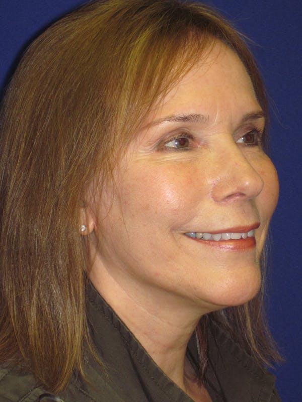 Facelift/Mini-Facelift Before & After Gallery - Patient 4890484 - Image 4