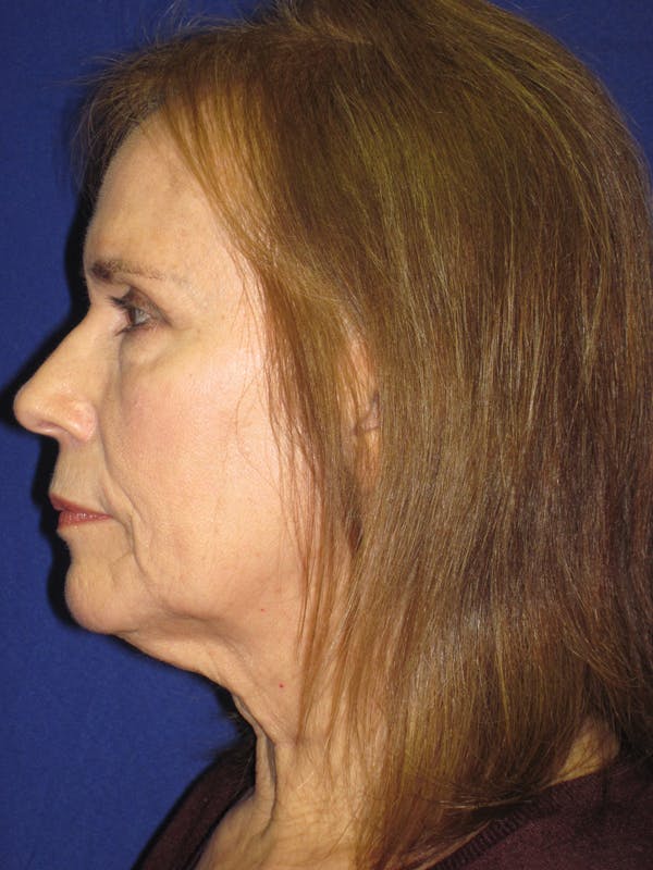 Facelift/Mini-Facelift Before & After Gallery - Patient 4890484 - Image 5